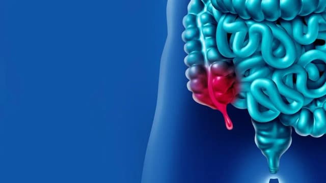 Jakie badania na wyrostek — kluczowe informacje o diagnostyce zapalenia. Jakie badania na wyrostek — kluczowe informacje o diagnostyce zapalenia.