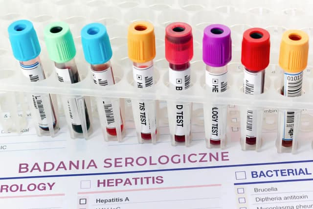 Badania serologiczne – co to jest i jakie mają zastosowanie w diagnostyce Badania serologiczne – co to jest i jakie mają zastosowanie w diagnostyce