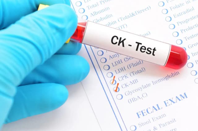Czym jest badanie CPK? Kluczowe informacje o kinazie kreatynowej Czym jest badanie CPK? Kluczowe informacje o kinazie kreatynowej