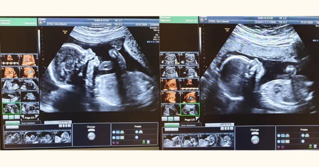Jak wyglądają pierwsze badania prenatalne i dlaczego są tak ważne? Jak wyglądają pierwsze badania prenatalne i dlaczego są tak ważne?