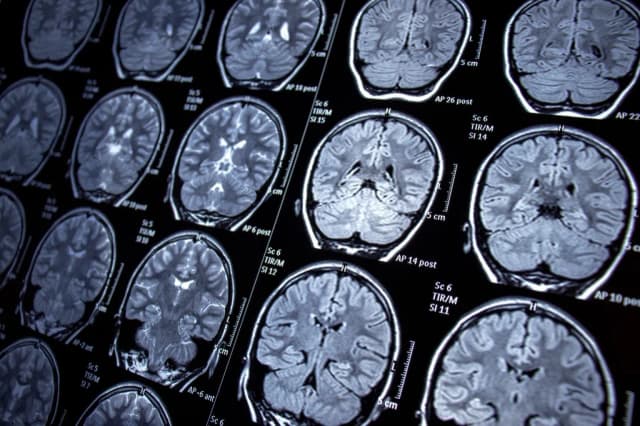 Padaczka - jakie badania są kluczowe w diagnostyce tego schorzenia? Padaczka - jakie badania są kluczowe w diagnostyce tego schorzenia?