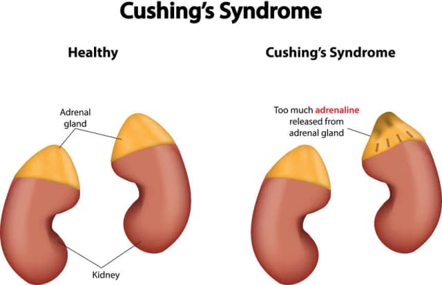Zespół Cushinga: Jakie badania diagnostyczne są niezbędne dla zdrowia? Zespół Cushinga: Jakie badania diagnostyczne są niezbędne dla zdrowia?
