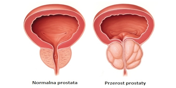 Przerost prostaty i gruczołu krokowego